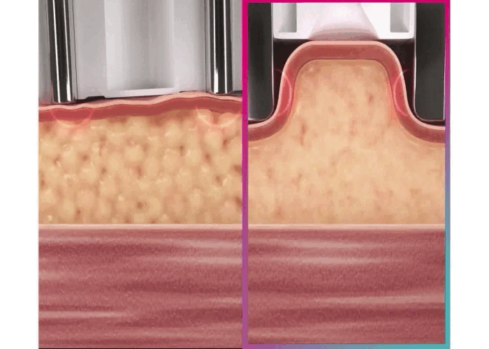 （左）原有方式；（右）Age-R Body Shot吸入口