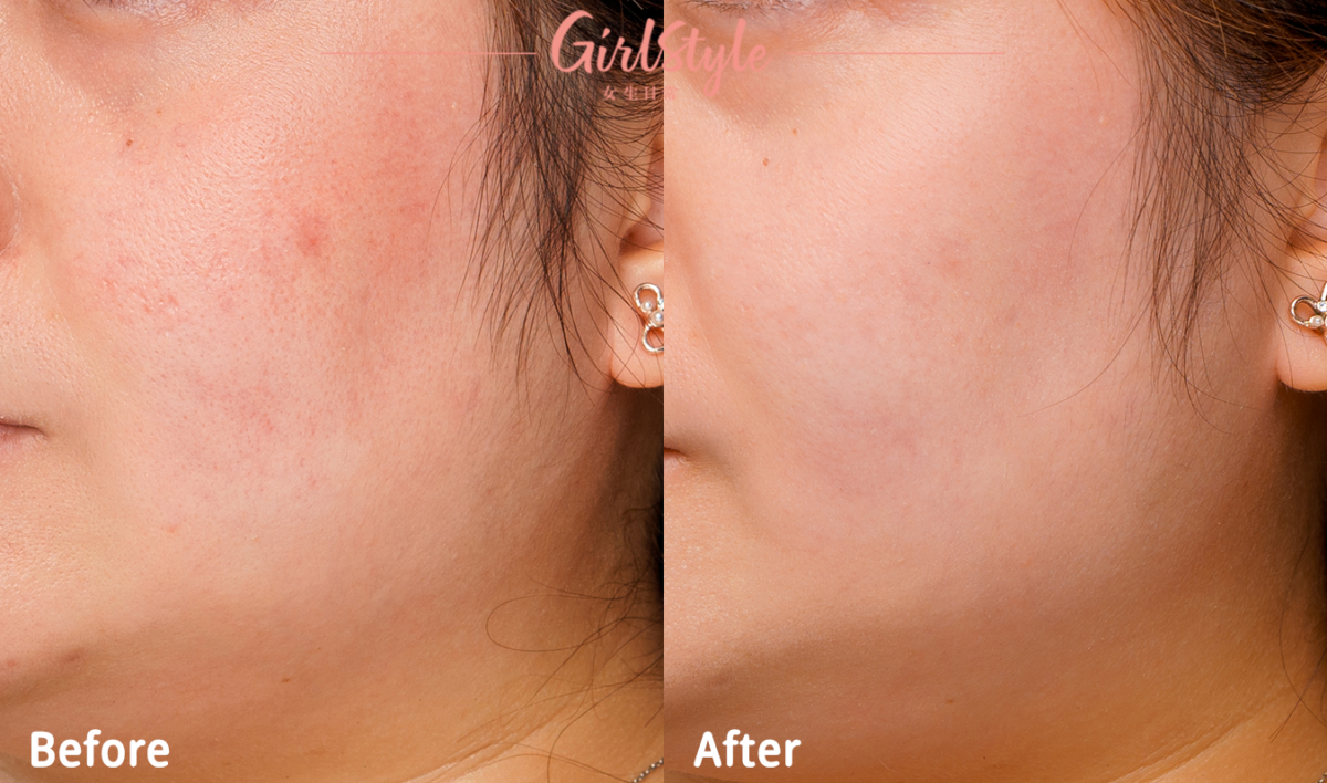 Ka Ling表示「搽入臉益生菌」令膚況明顯穩定，敏感、痕癢通通大大改善！真心推介！