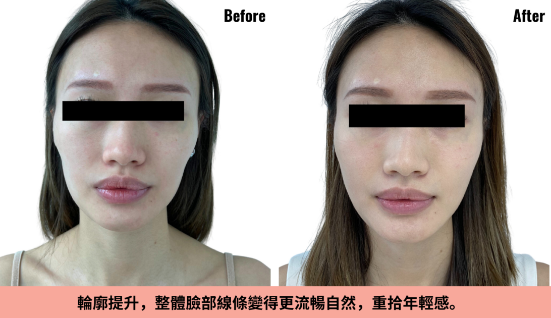 RADIESSE®膠原彈力針療程前後對比圖。
