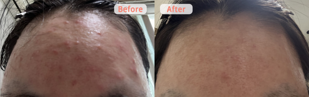 乾敏肌的韓國女生持續使用Gelato潔面霜1個月，皮膚更變得細緻平滑。