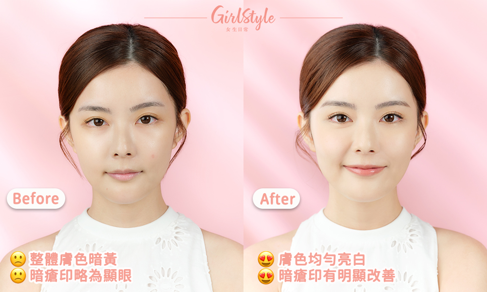 美編使用CLARINS全新透亮速效安瓶 x 淡斑精華一段時間後,暗瘡印也消失了,整體膚色變得均勻透亮。