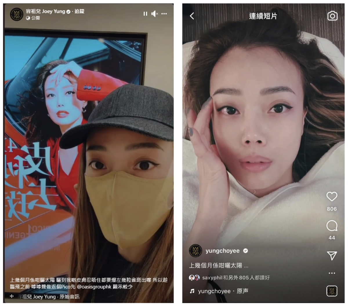 天后Joey大愛Pico4Genius皮秒激光去斑療程。