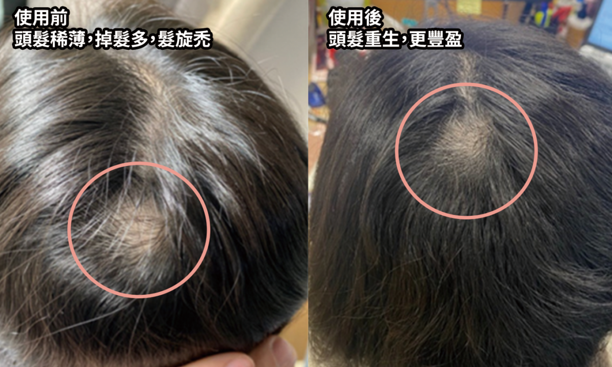 使用維新烏絲納米激活生髮洗髮精華露後,髮根明顯更強韌,超過90%用家認同頭髮濃密度增加¹!