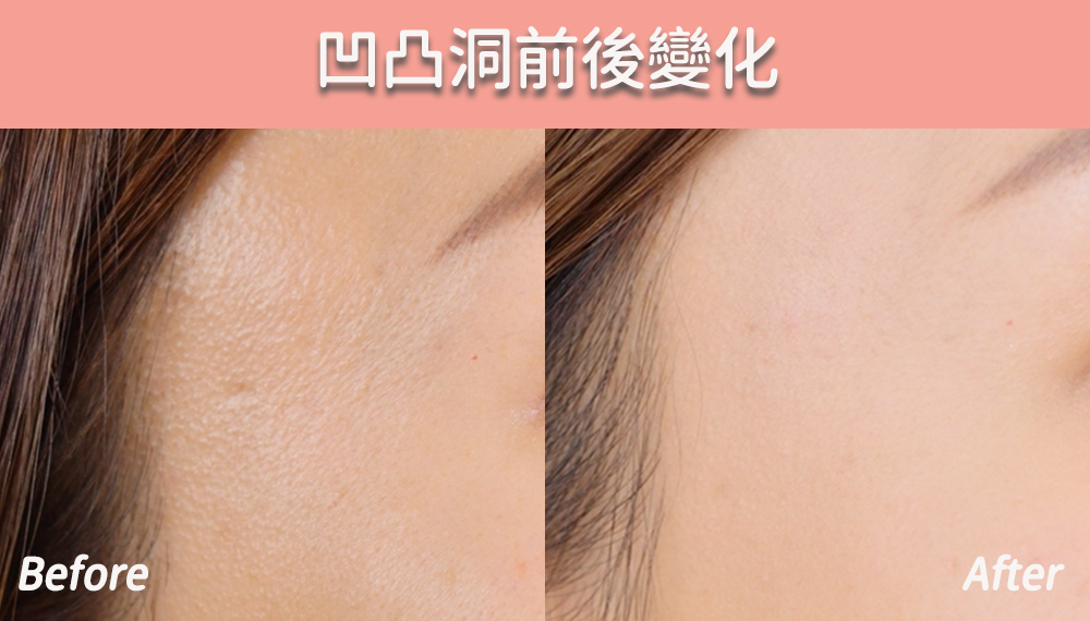 美編做用JULAINE前後凹凸洞的變化