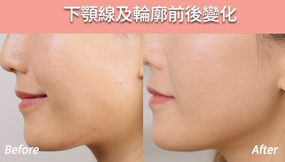 美編做用JULAINE前後下顎線及輪廓的變化
