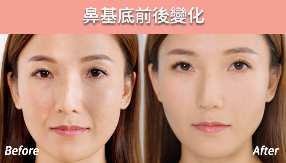 美編做用JULAINE前後鼻基底的變化