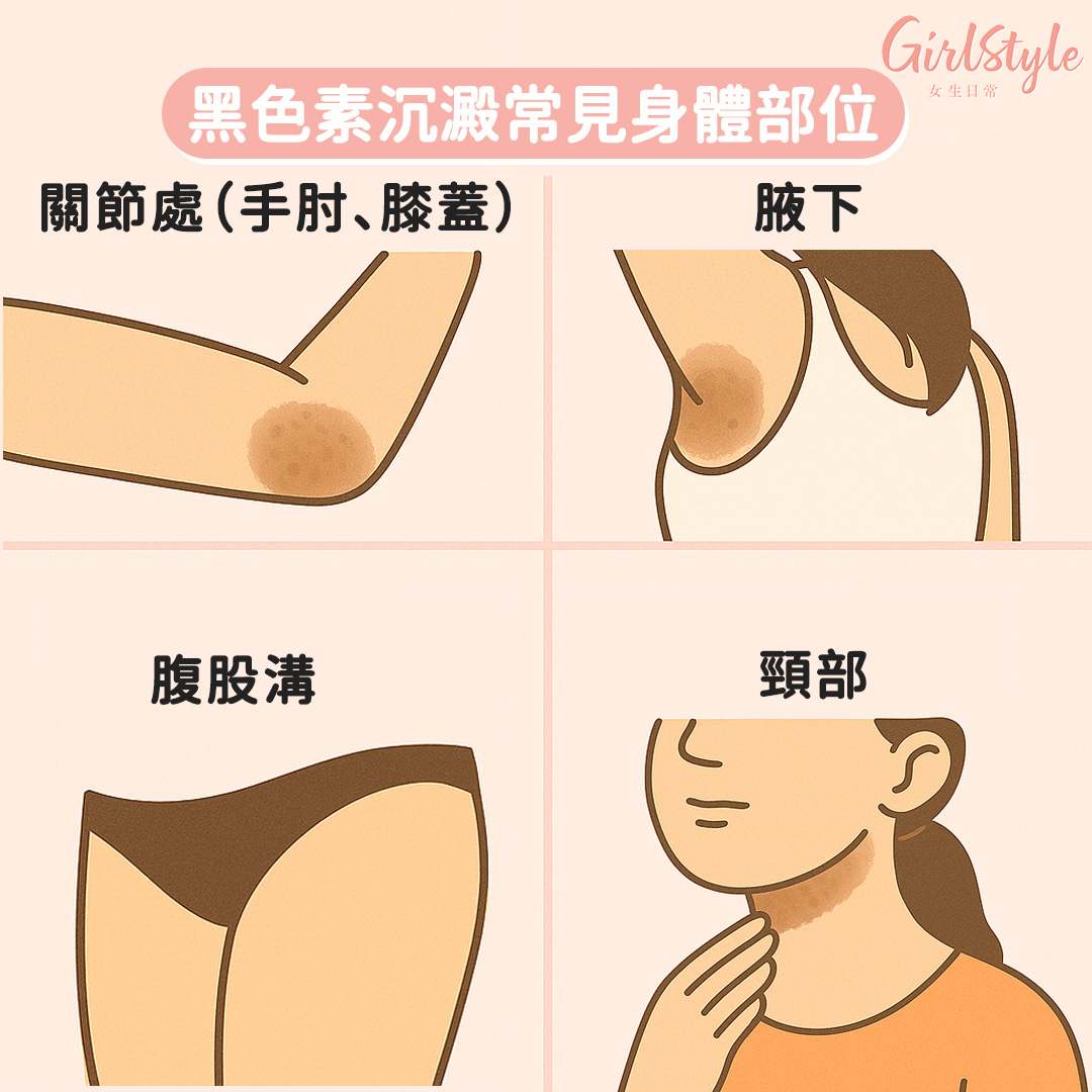 黑色素沉澱不只發生在臉部，身體其他部位變黑也很常見。