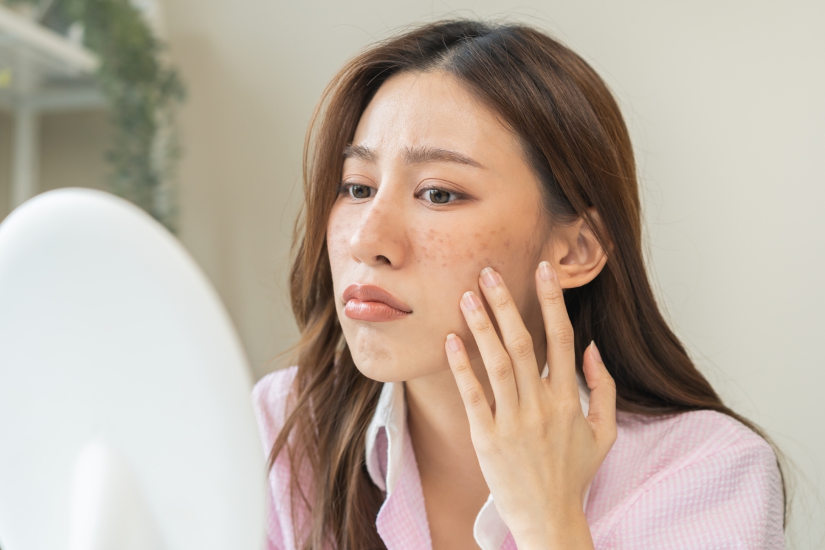 不同色斑形成原因各異,對應的淡斑對策也會不同。