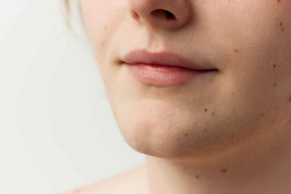 痣在醫學上稱為「黑色素細胞痣」，是由皮膚中的黑色素細胞聚集而成，屬於常見的良性皮膚變化。