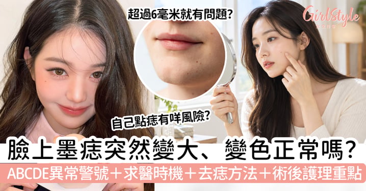 【臉上墨痣】突然變大正常嗎？ABCDE病變警號、去痣方法與術後護理