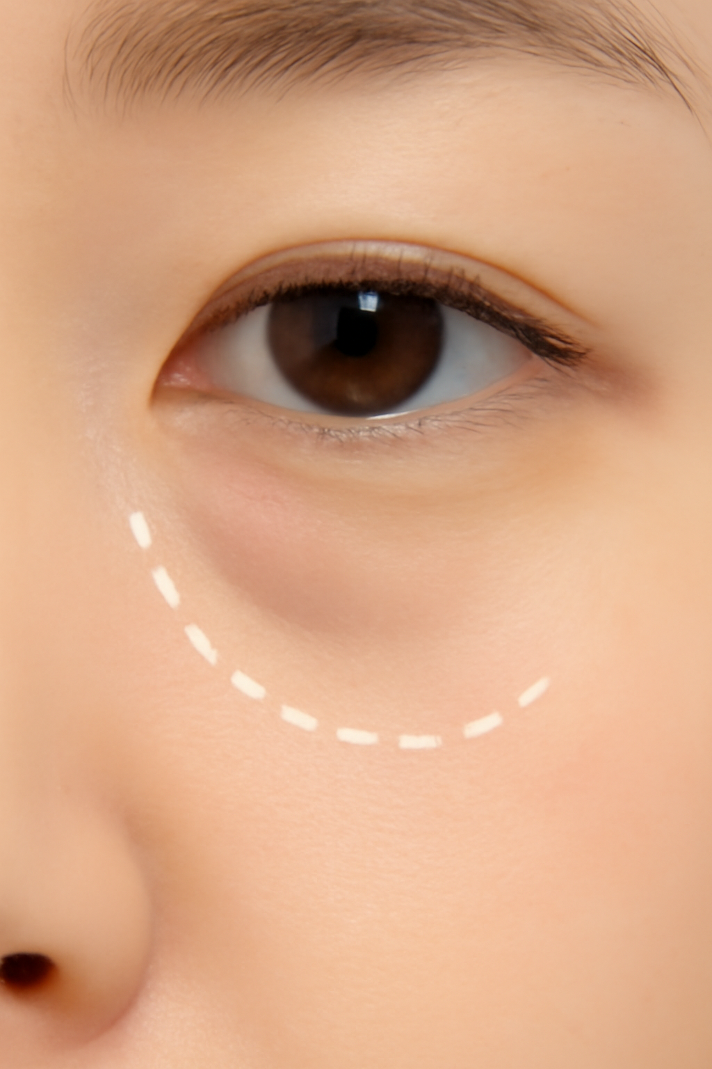 淚溝型眼袋通常在眼下內側有明顯的凹陷陰影