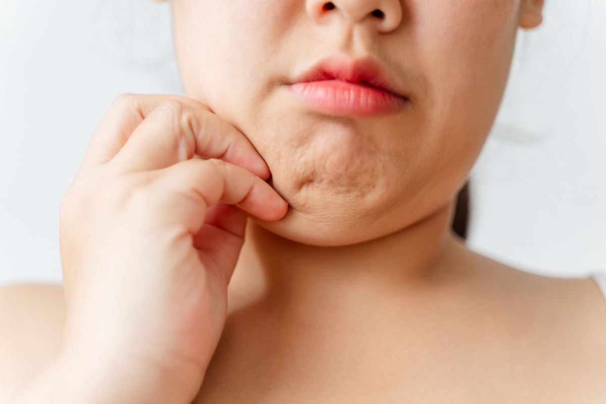 雙下巴不一定只跟肥胖有關，即使是身材纖瘦的人，也可能因為脂肪堆積、皮膚鬆弛或天生臉型等原因而有雙下巴。