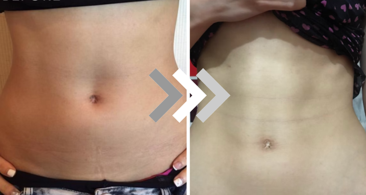 一個月八次療程後,明顯肌肉變得結實