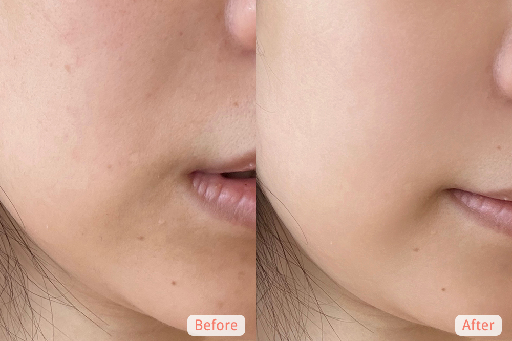 Alexandra試用Avene精華後肌膚狀態的前後對比