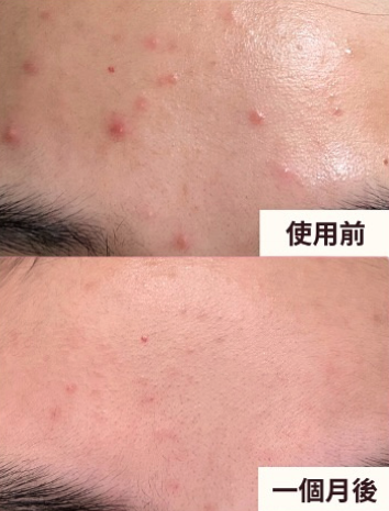 從「爛臉」變「發光肌」超驚人！