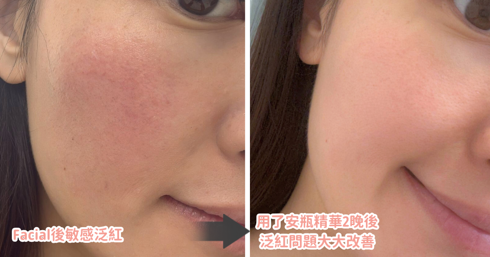 早前肌膚敏感，用全新紅金安瓶精華³2晚，瞬間降紅，效果明顯！