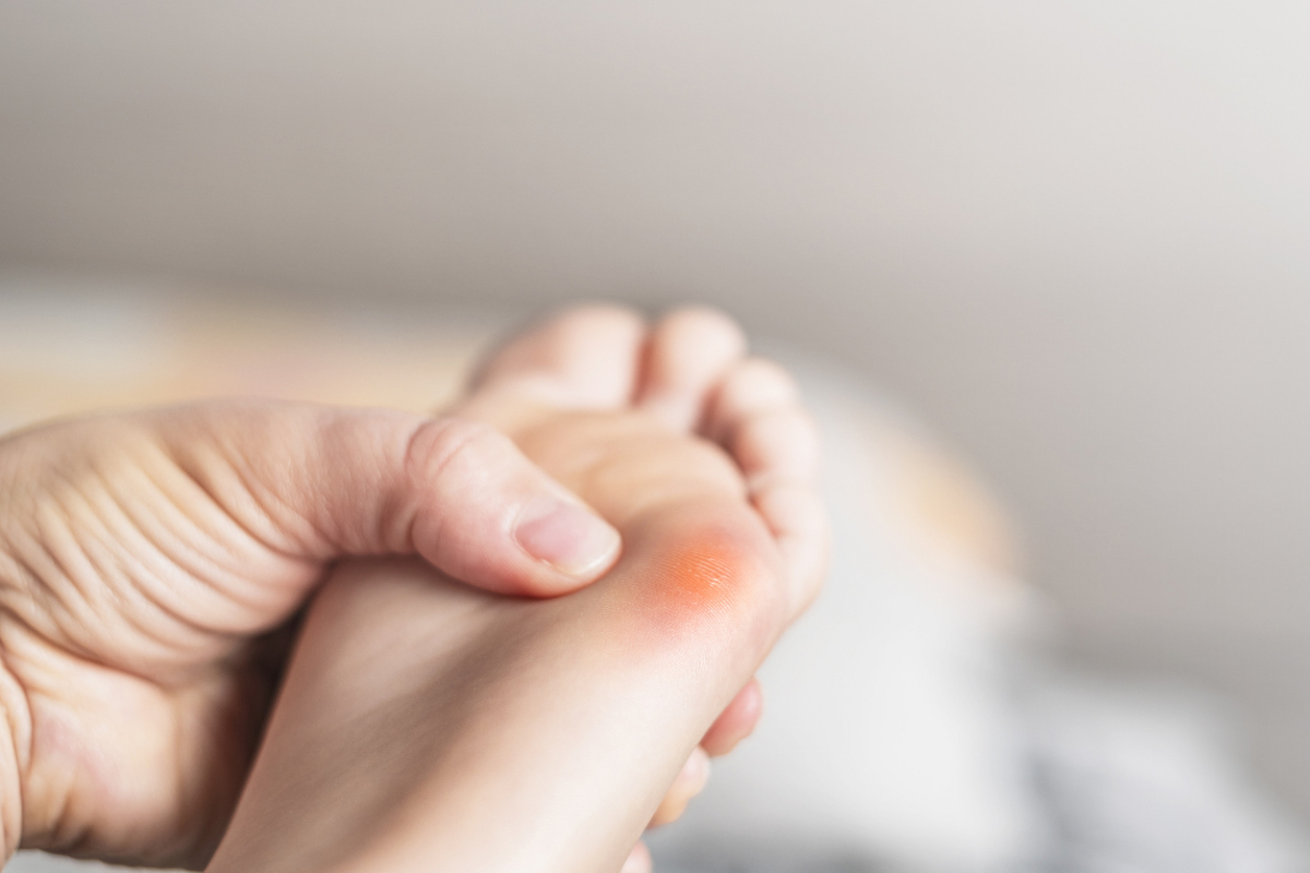 雞眼的症狀是局部皮膚增厚、呈圓錐狀且中央有淡黃色硬核，按壓或走路時會有明顯疼痛。