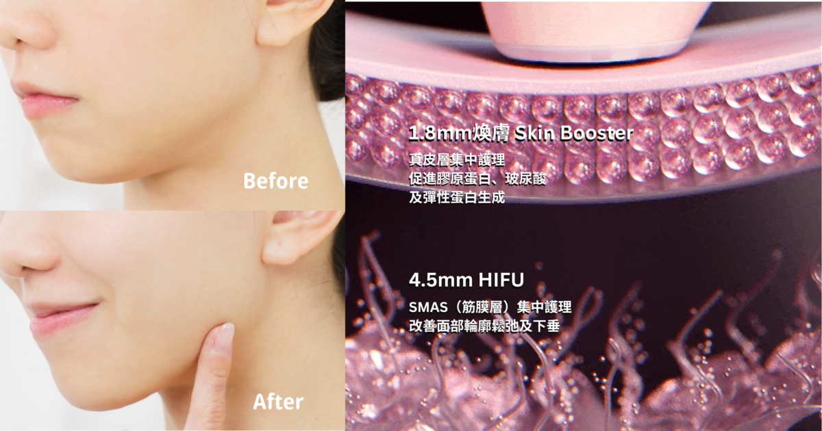 HIFU × Skin Boosting，提拉效果超明顯
