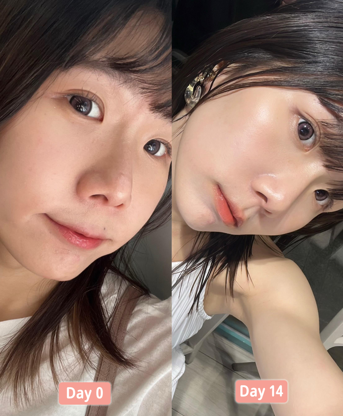 真實用家Gillchung1227試用OLAY水光小白瓶²前後的膚況。