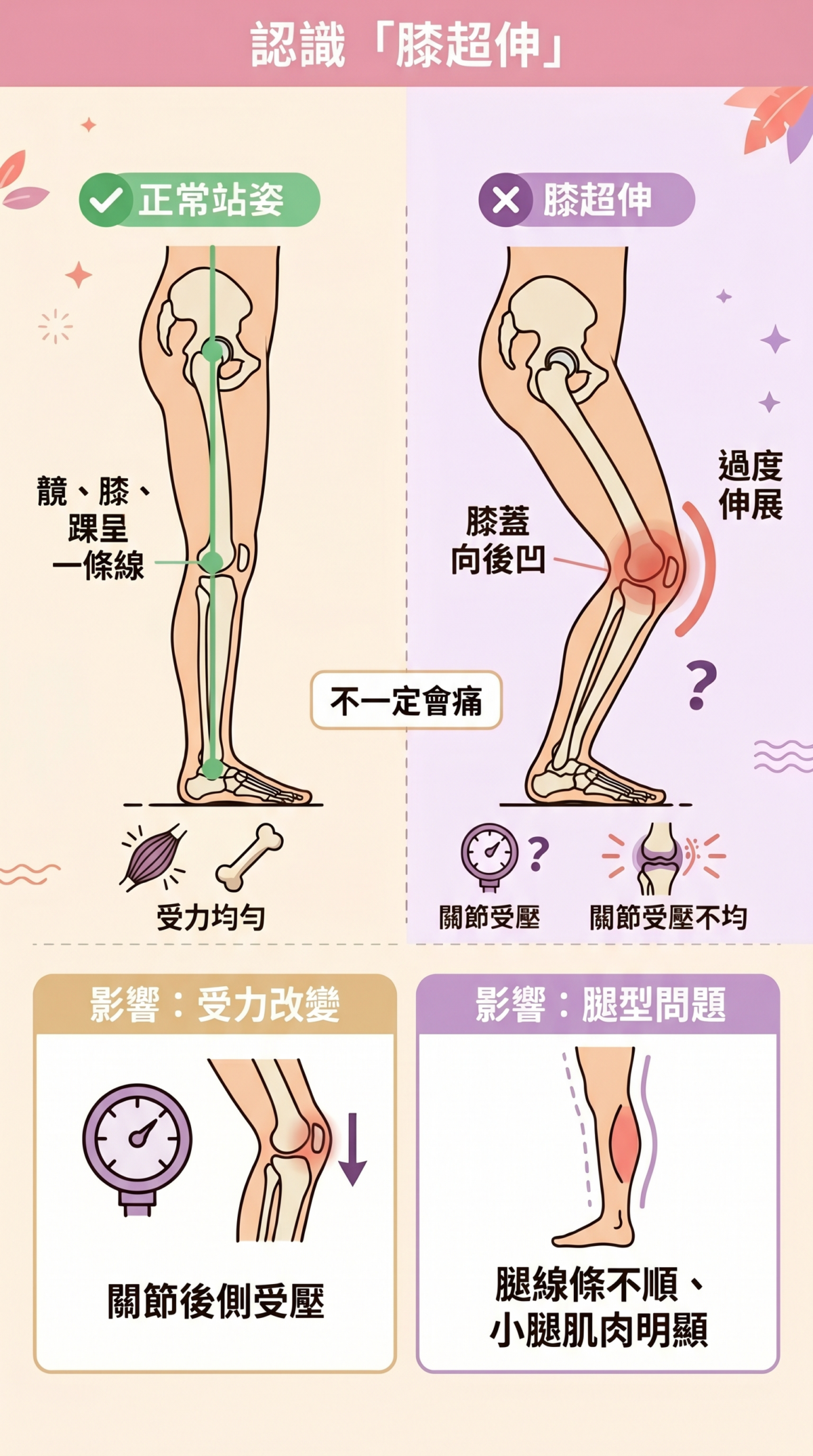 膝超伸與正常膝蓋站姿對比示意圖，展示正常直線排列與反曲膝向後凹陷的角度差異。