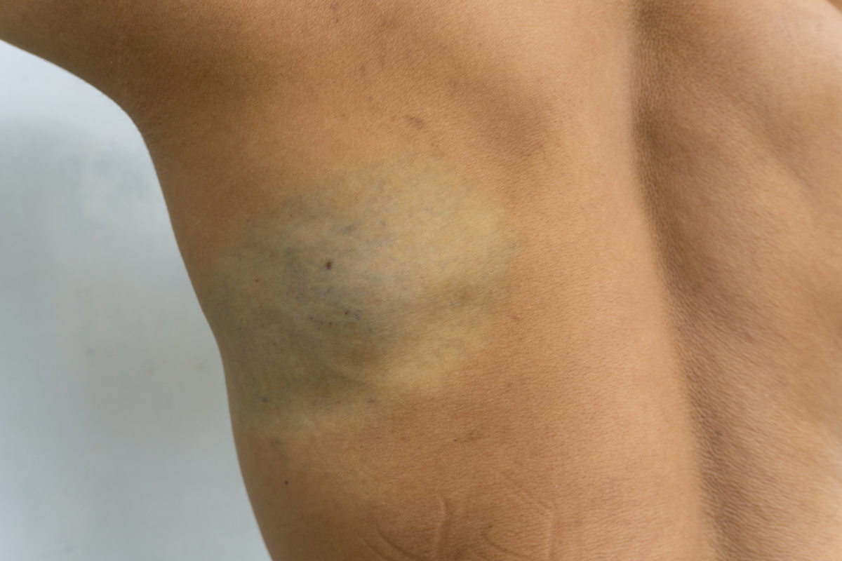 洗紋身通常要分5至10次左右慢慢淡化，因為每次只能打碎部分色料，之後還要靠身體代謝和皮膚修復，所以很難一次就完全洗掉。