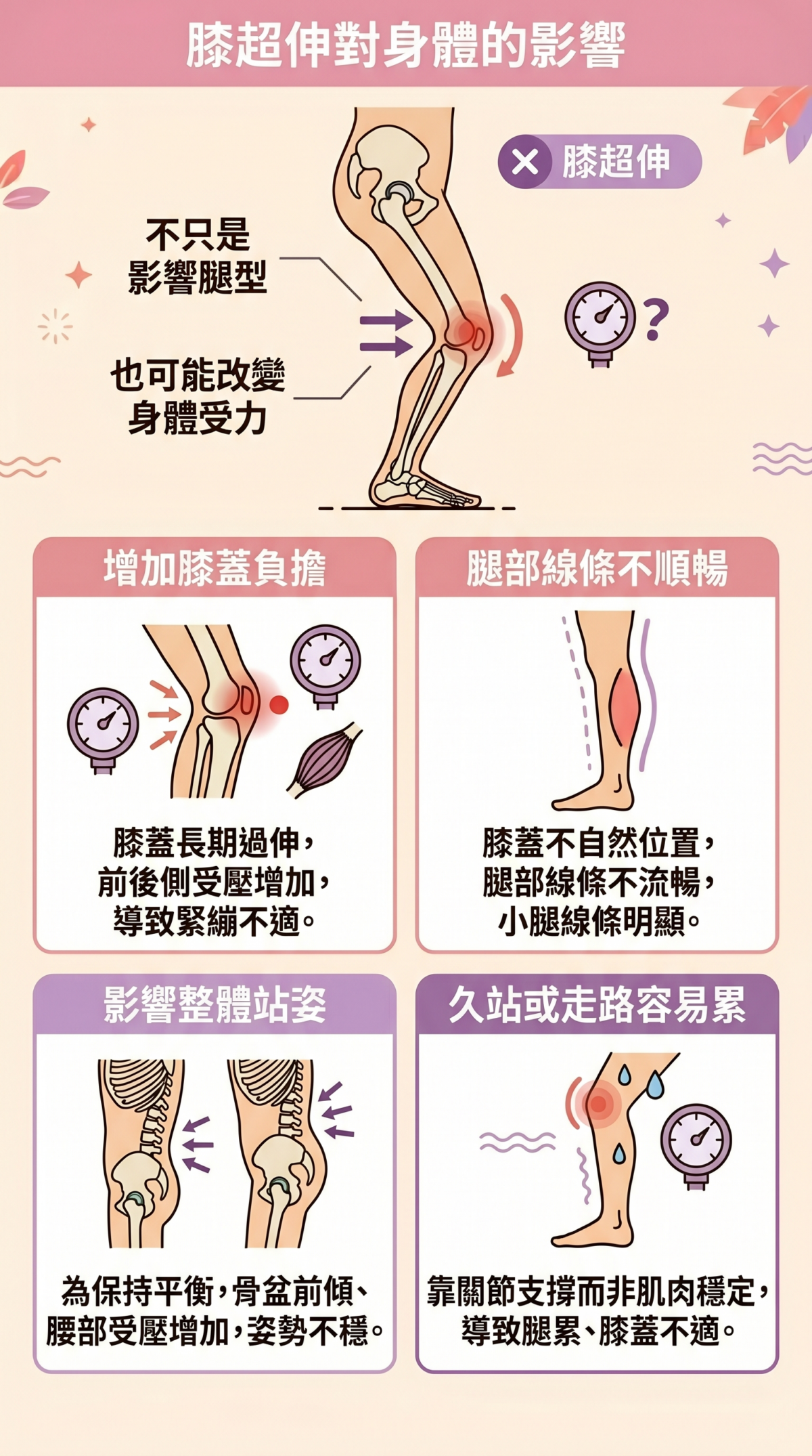 膝超伸連鎖影響示意圖，展示膝蓋過伸如何導致骨盆前傾、腰椎受壓以及小腿肌肉緊繃的體態代償過程。