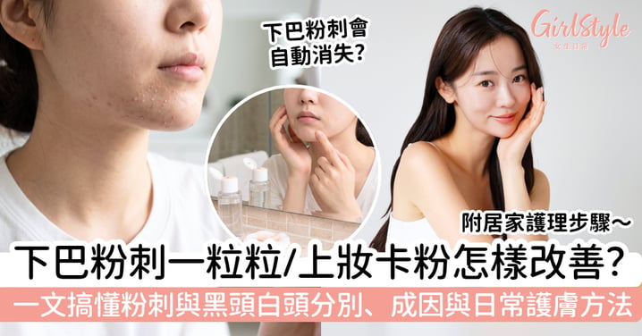 【下巴粉刺2026】下巴一粒粒、上妝卡粉怎樣改善？黑頭白頭分別、成因與日常護膚方法