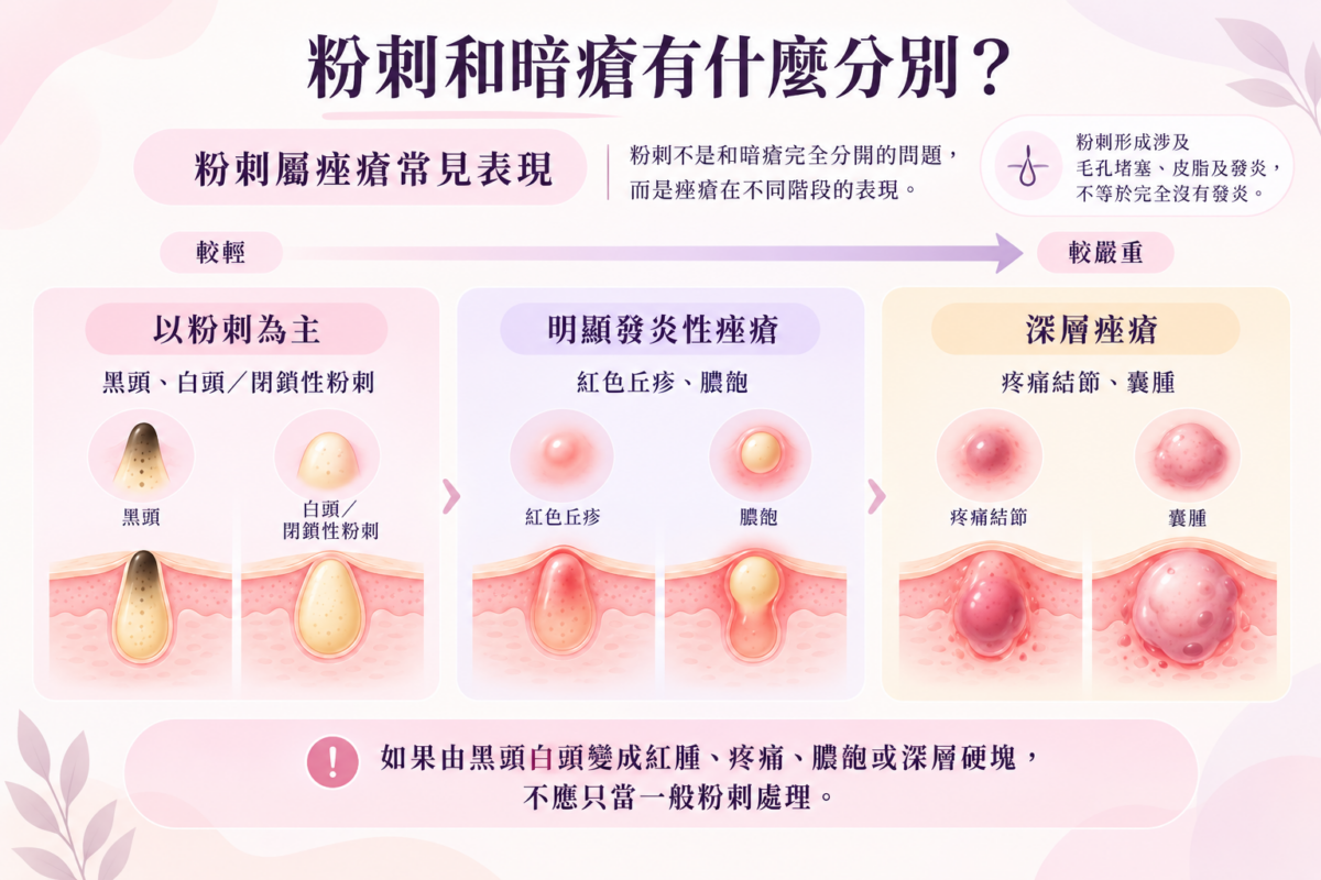 粉刺與暗瘡差別對照圖：解析黑頭白頭粉刺演化至紅色丘疹、膿皰及深層結節囊腫的痤瘡嚴重程度分級。