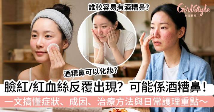 【酒糟鼻】臉紅、紅血絲反覆出現?酒糟鼻症狀、成因、治療方法與日常護理重點