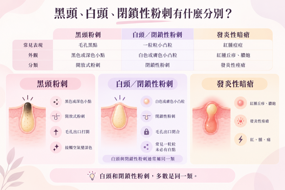 黑頭粉刺、白頭閉鎖性粉刺與發炎性暗瘡的外觀特徵及醫學分類對照圖。