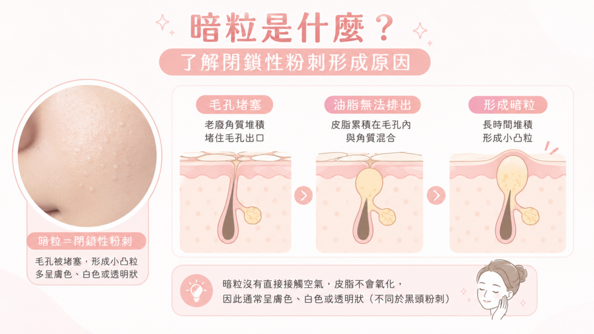 暗粒在醫學上稱為「閉鎖性粉刺（Closed Comedones）」，主要是因為毛孔出口被老廢角質堵塞，導致皮脂無法順利排出。