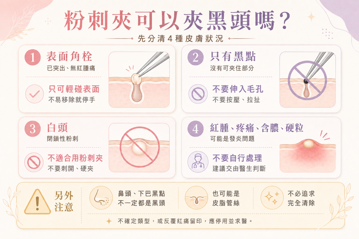 4種皮膚狀況是否適用粉刺夾判斷圖：突出角栓、平坦黑頭、白頭粉刺與紅腫暗瘡的處理建議對照。