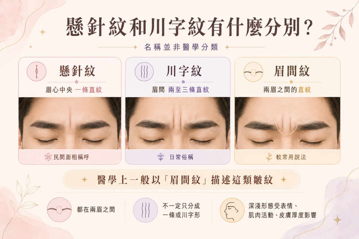 懸針紋與川字紋差異比較圖:圖解眉心一條直紋的懸針紋與多條直紋的川字紋外觀特徵,並說明兩者在皮膚醫學上皆統稱為眉間紋。
