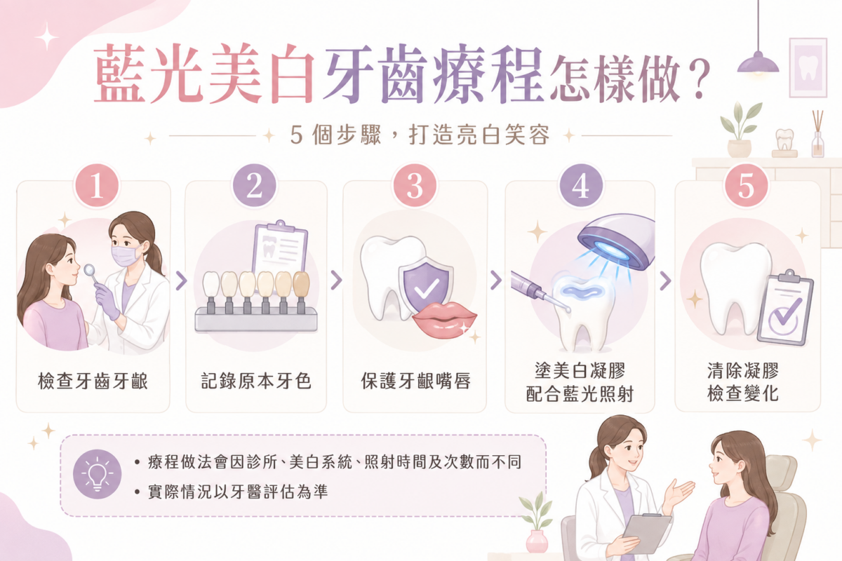 診所藍光美白牙齒5大療程步驟流程圖：包含口腔檢查、記錄齒色、牙齦保護、藍光照射及成效評估。