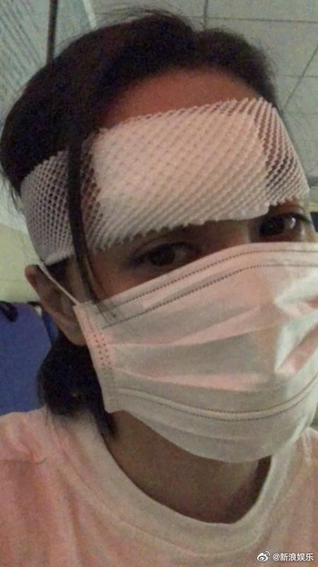 早前阿嬌喺廈門拍戲，點知於下榻酒店房間發生意外，頭部受傷