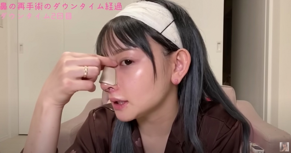 Misa第一項整容就係打玻尿酸，之後陸續做過削骨手術、先後3次墊鼻