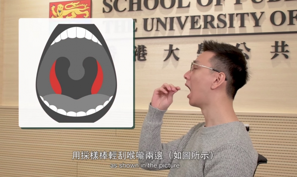 做法為採樣時應該先撩喉,之後用同一支棒撩兩邊鼻。