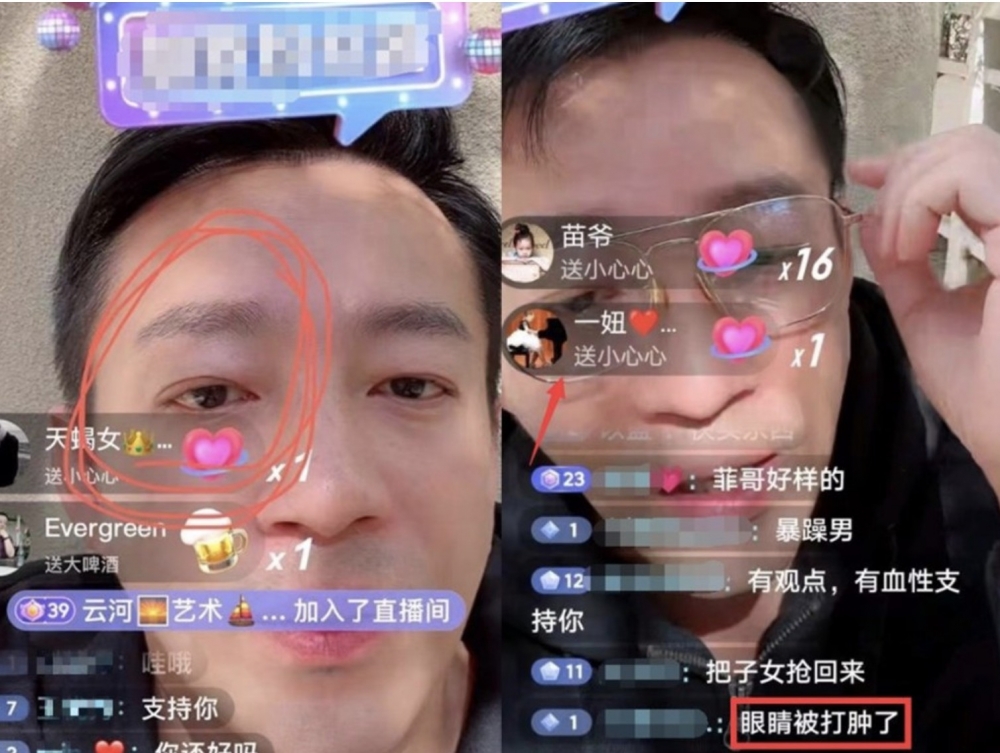 汪小菲事隔多日開抖音直播,被網民發現右眼疑似受傷!
