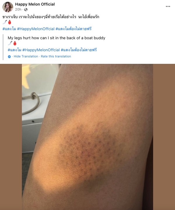 Fb上亦有疑似係Tangmo身前腿部有瘀傷嘅照片