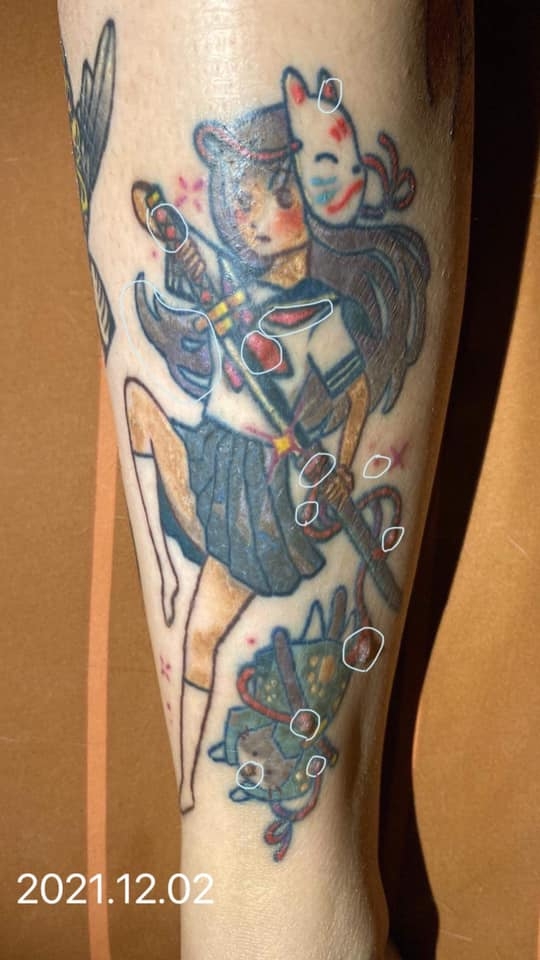 除咗化線，事主皮膚更敏感發炎，需要求醫治理