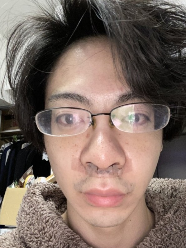 近年喺Twitter、Instagram、TikTok等都有好多網友分享自己嘅整容經歷