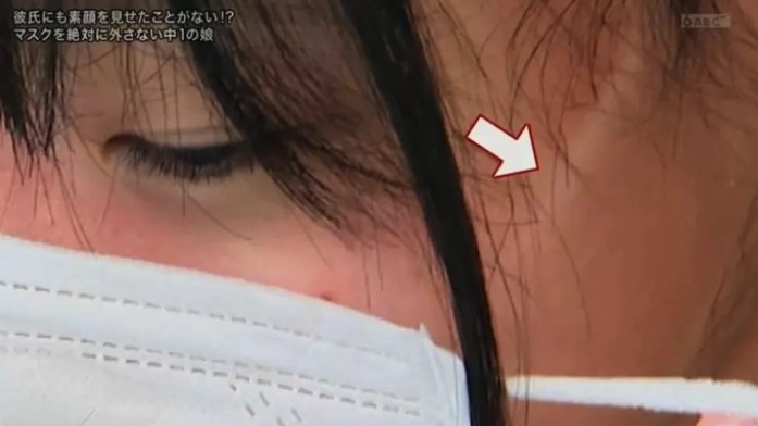 少女因為長期戴住口罩，連塊面都有「口罩印」！