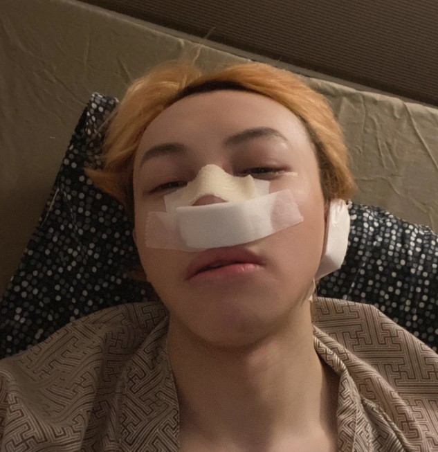 而鼻子方面佢就選擇收窄鼻翼 