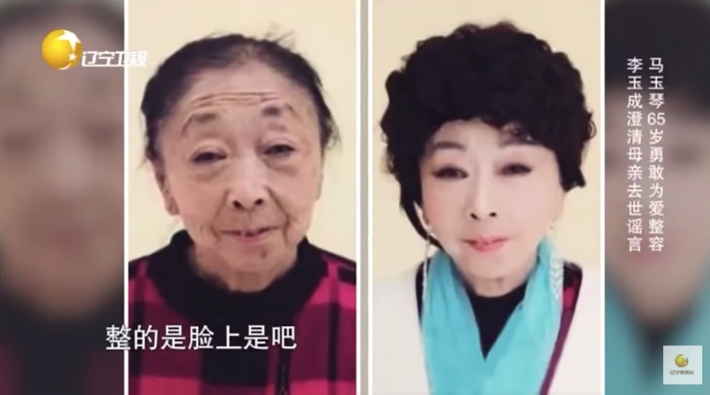 馬玉琴整容前後對比照