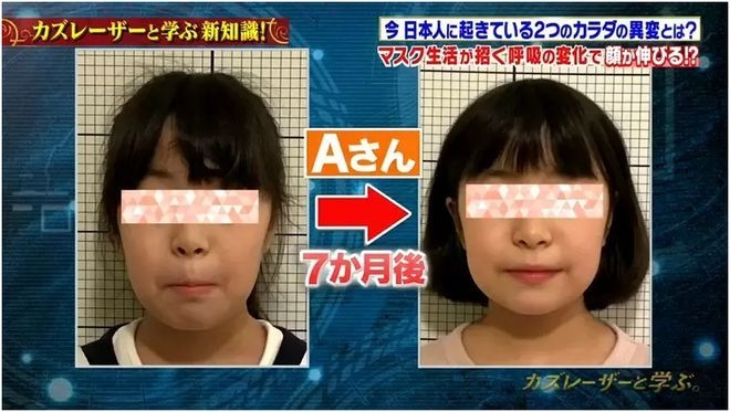 戴咗口罩約7個月嘅兒童對比照