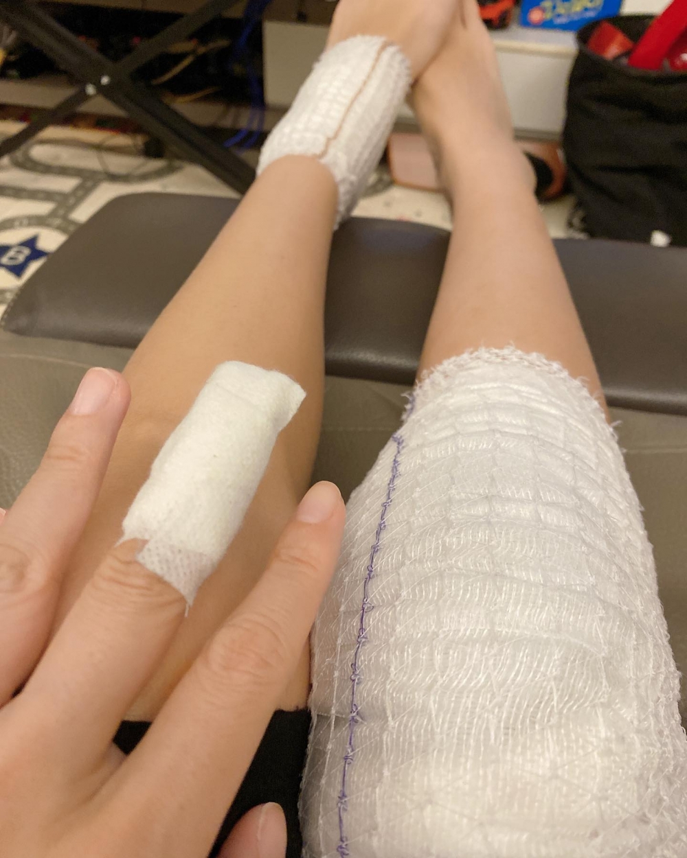 車婉婉喺去年3月貼出自己手、腳纏繃帶嘅相。