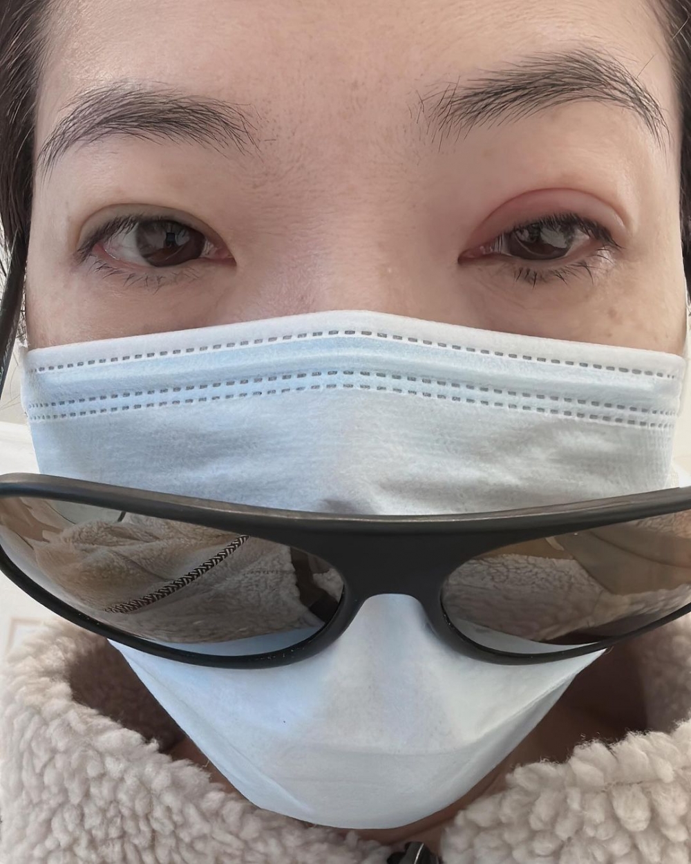 車婉婉於社交平台上貼出眼部受傷照片。