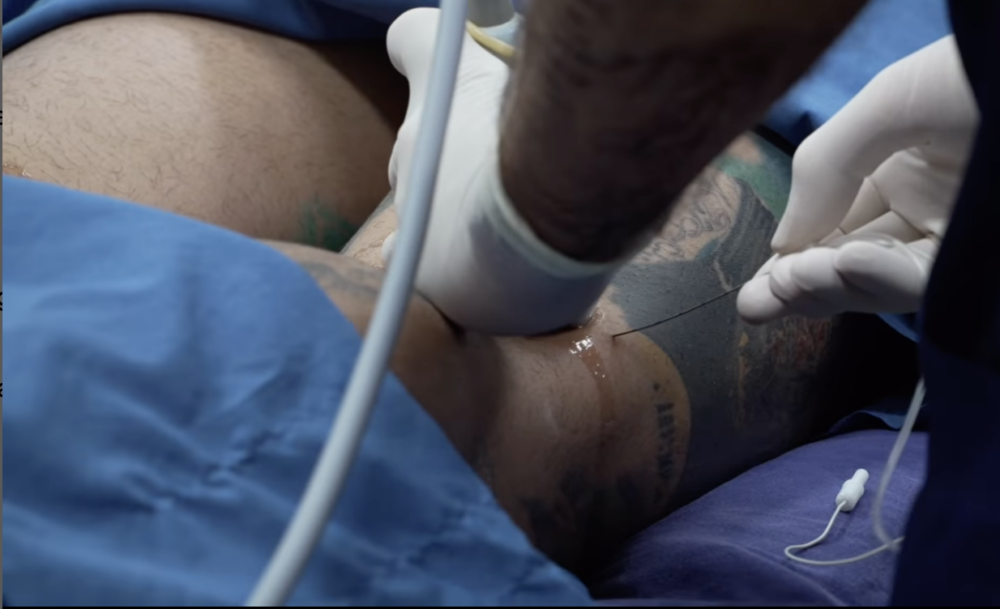 耶佛森起初向粉絲謊稱自己是因腿部缺陷才動手術，後來才承認純粹是外觀因素