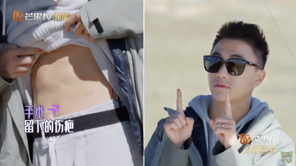 何猷君更喺節目中公開手術後喺肚上嘅疤痕