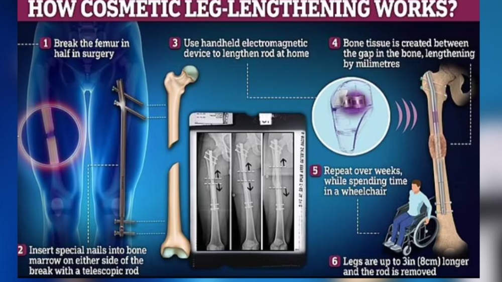 據悉，這項手術需要打斷患者的腿骨，並在腿骨內安裝1條金屬棒和數顆螺絲固定